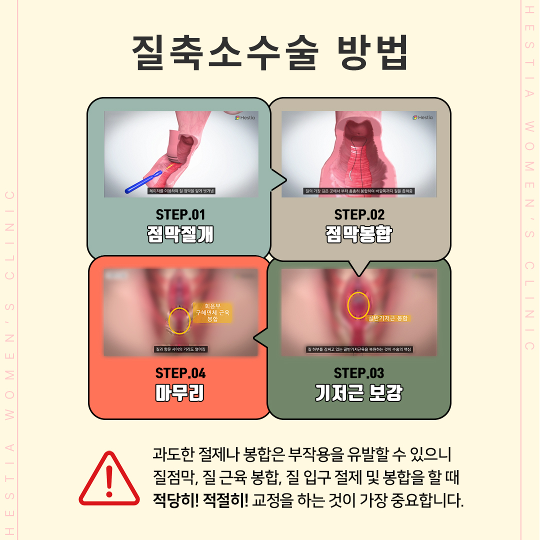질성형
질수축