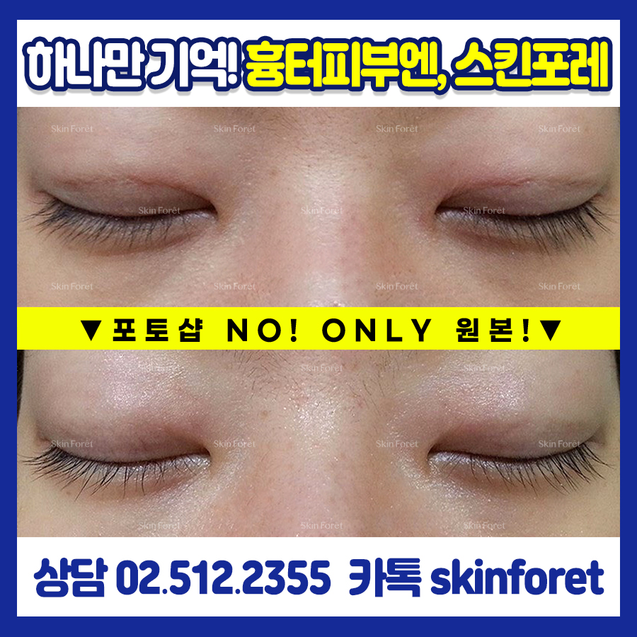 쌍꺼풀재수술 후 남은 눈가 흉살 관리 사례