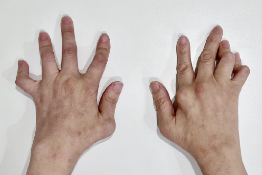 손가락 류마티스 관절염 주요 증상과 체크 리스트