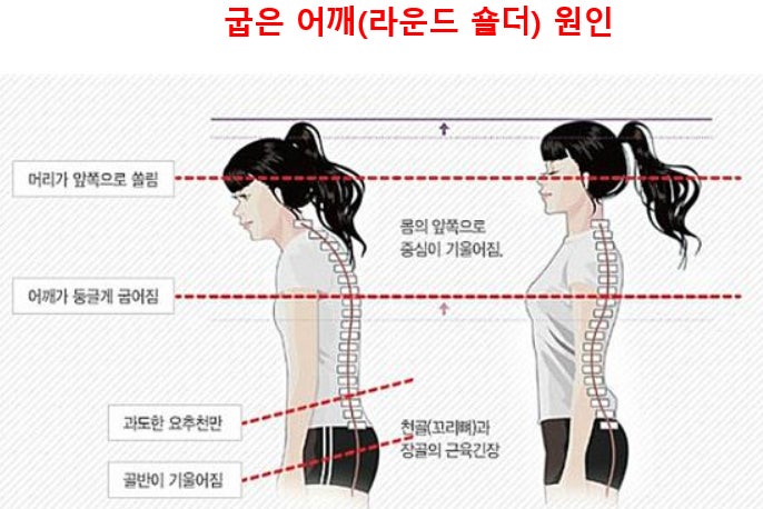 굽은 어깨 관련 사진