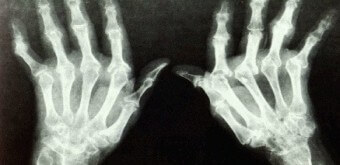 류마티스 관절염 초기증상