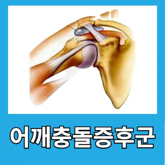 "직장인 어깨통증"