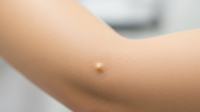 고지혈증 증상 피부결절 단서