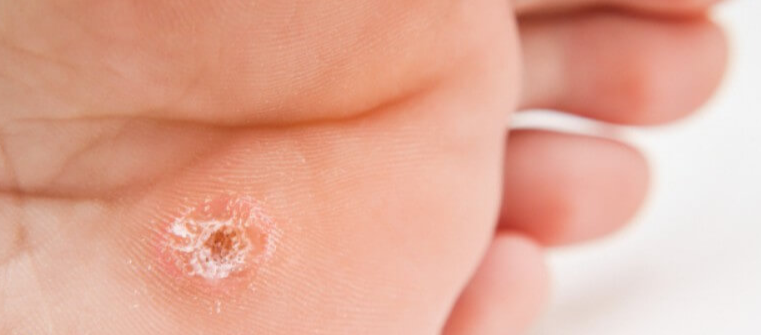 티눈-생기는-이유