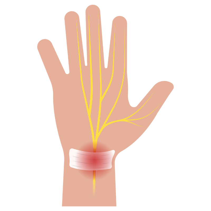 손목터널증후군 증상