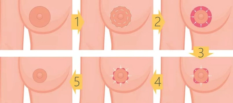 유륜 축소 수술