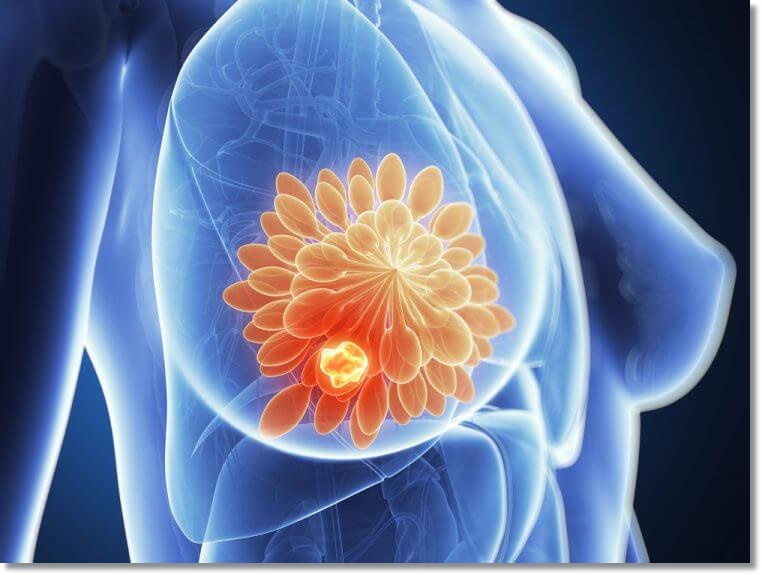 유방암이 퍼지게 되는 상황