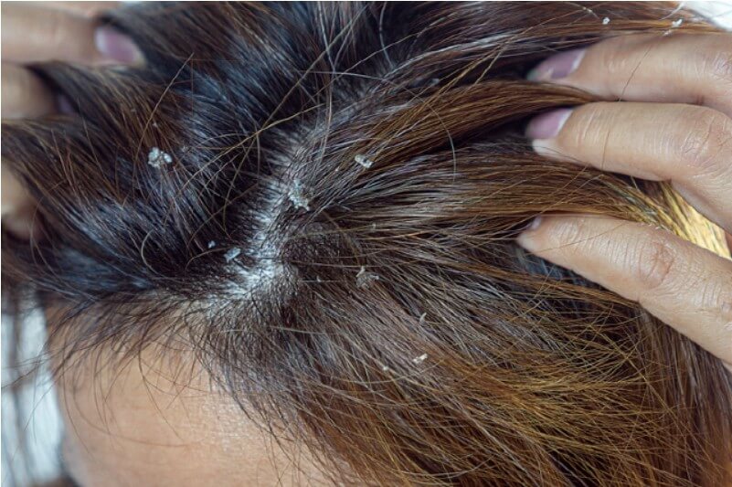 비듬이-생기는-원인