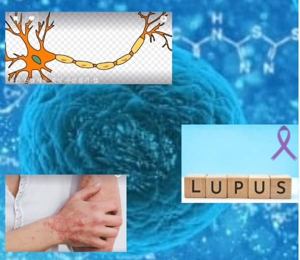 자가면역질환 2탄-다발성 경화증, 루푸스, 건선