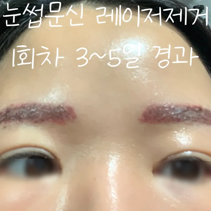 눈썹 문신 제거 방법 꿀팁_2