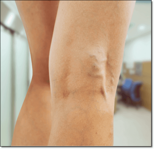 하지 정맥류 사진