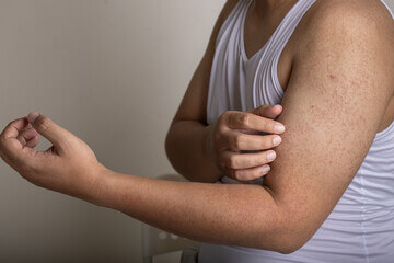 모공각화증 미스트 효과 있을까? 셀프 치료와 원인&amp;#44; 주요 증상들이 어떤 것들이 있는지 참고 하시기 바랍니다. 