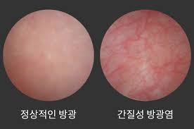 여성 방광염 증상