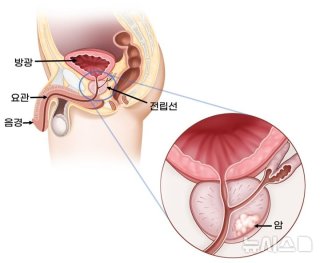 전립선암 증상