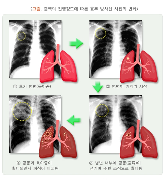 결핵 초기 증상 놓치지 마세요! 조기 발견 가이드