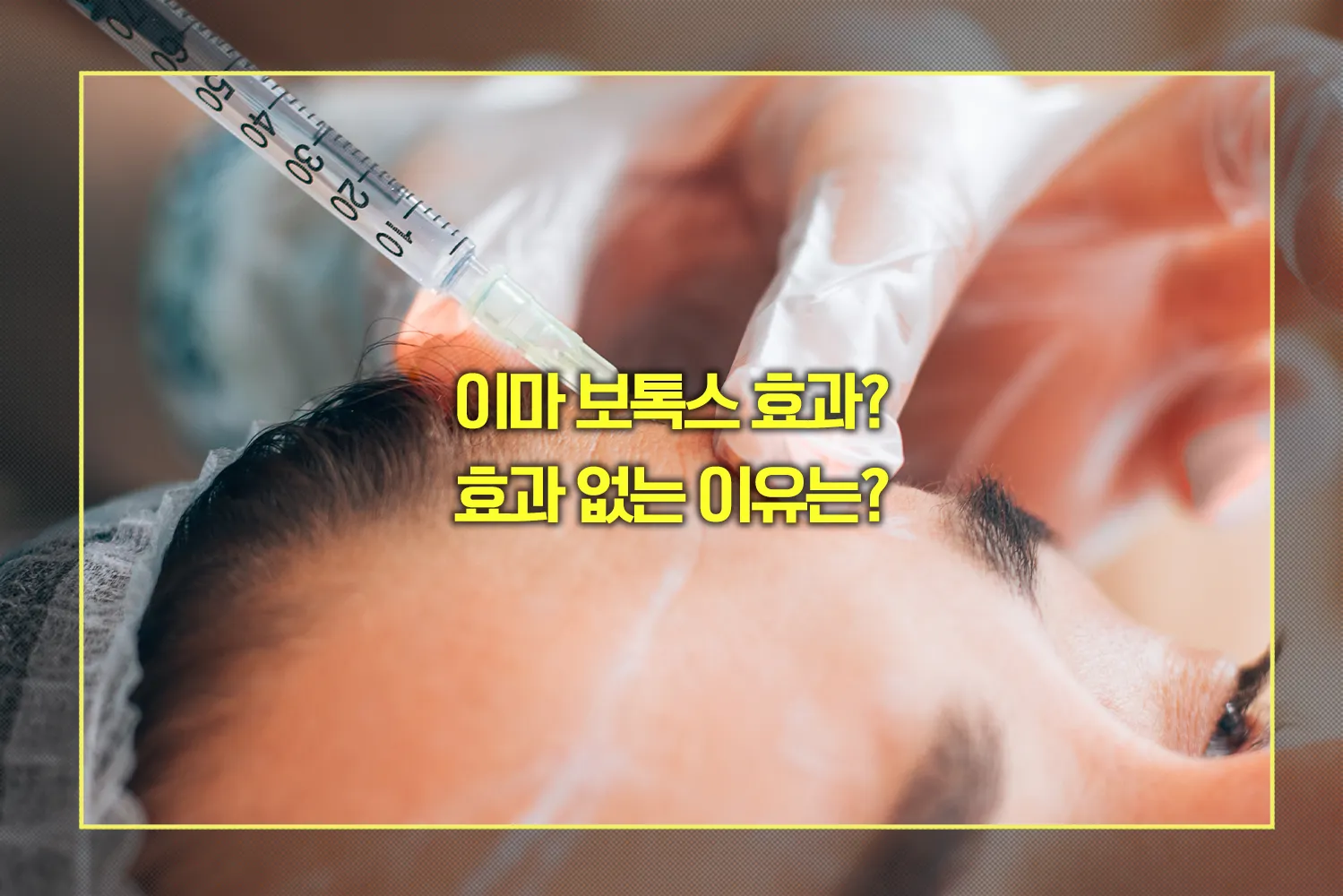 이마 보톡스 효과 없는 이유