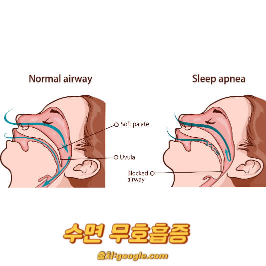 수면 무호흡증