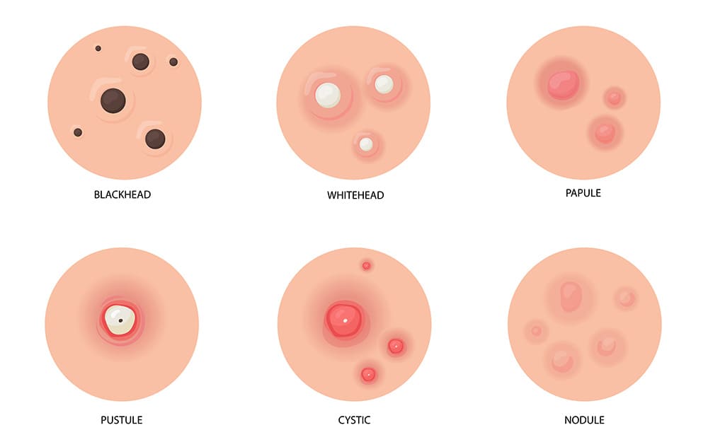 비립종-악화시키는-요인-TOP-5-및-예방법