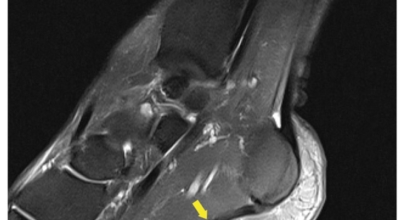 족저근막염 이미지