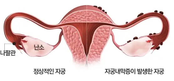 자궁내막증