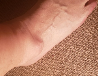 인대 파열 가능성