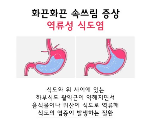 역류성식도염