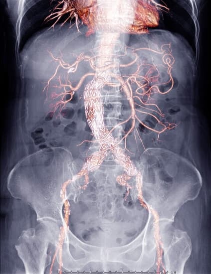 대동맥류(Aortic Aneurysm)