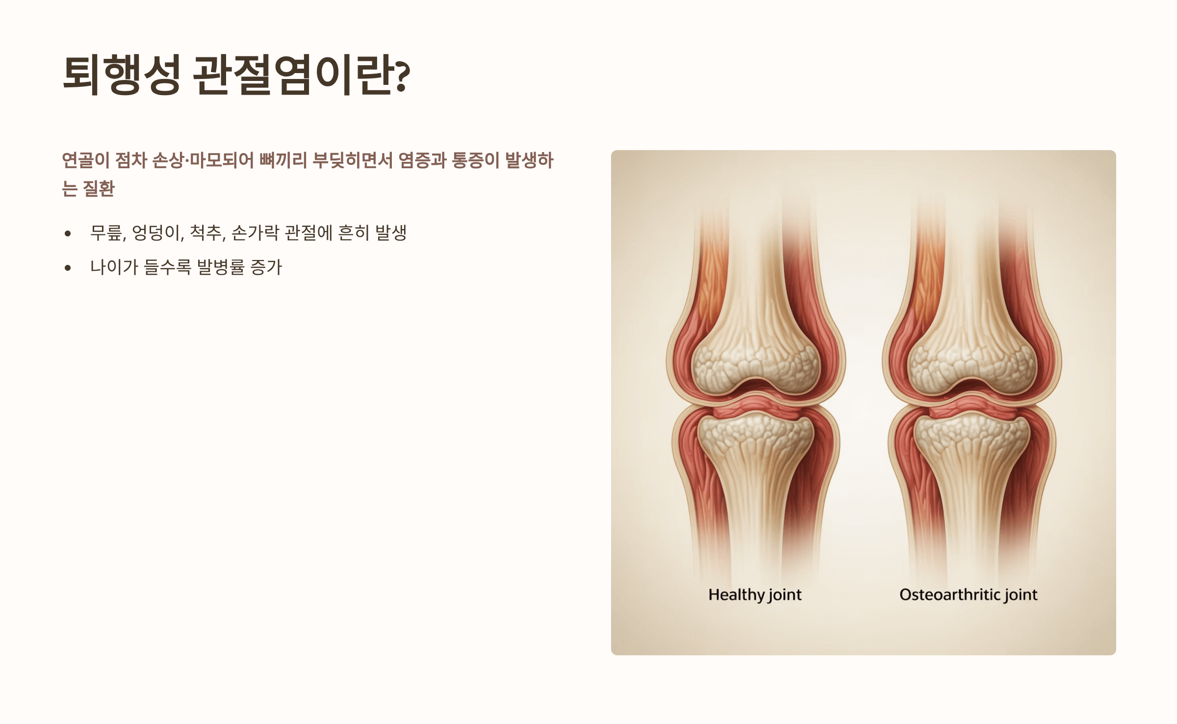 퇴행성 관절염 초기증상