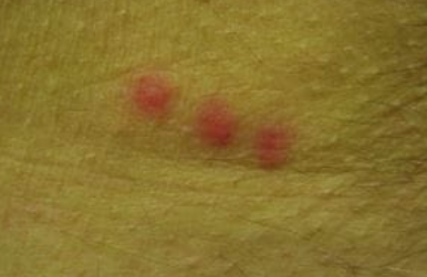 요즘 난리인 빈대 예방하는 방법