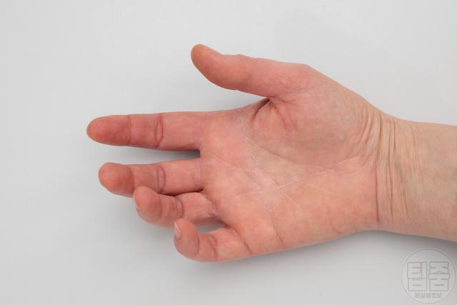 세로토닌 증후군 몸이 굳는 느낌