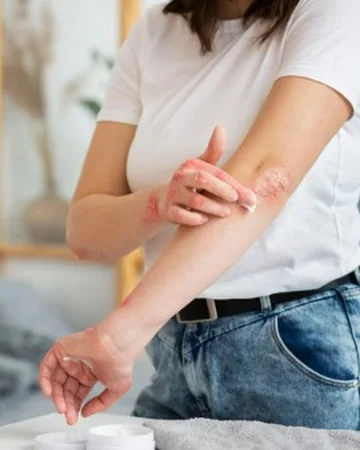 겨울철 알레르기 피부염으로 가려움과 건조함이 나타나는 피부 상태16