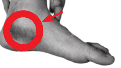 발목-안쪽-인대-늘어남-확인