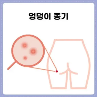 엉덩이 종기가 생기는 이유 왜 생기고 어떻게 관리할까요 완벽 가이드_8