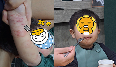 아기 아토피 관리로 식단 조절 없이 탈 스테로이드 성공한 이야기(보습/샤워/UVB램프) - 특정 제품 광고XXX