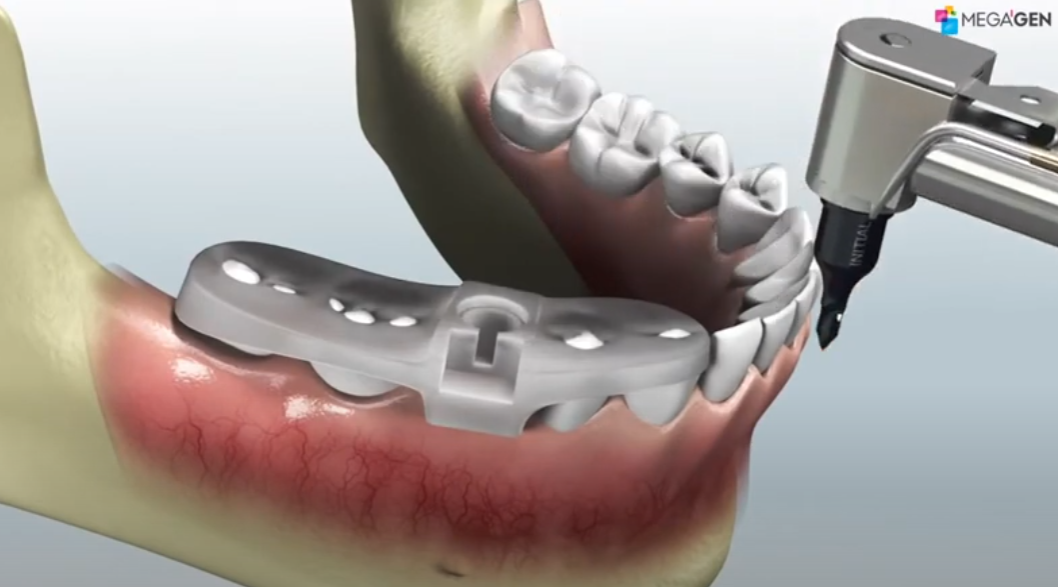 메가젠 r2임플란트