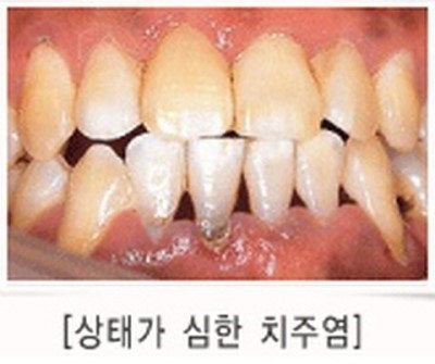 치주질환의 예