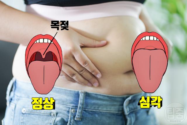 수면무호흡증 자가진단 체중증가