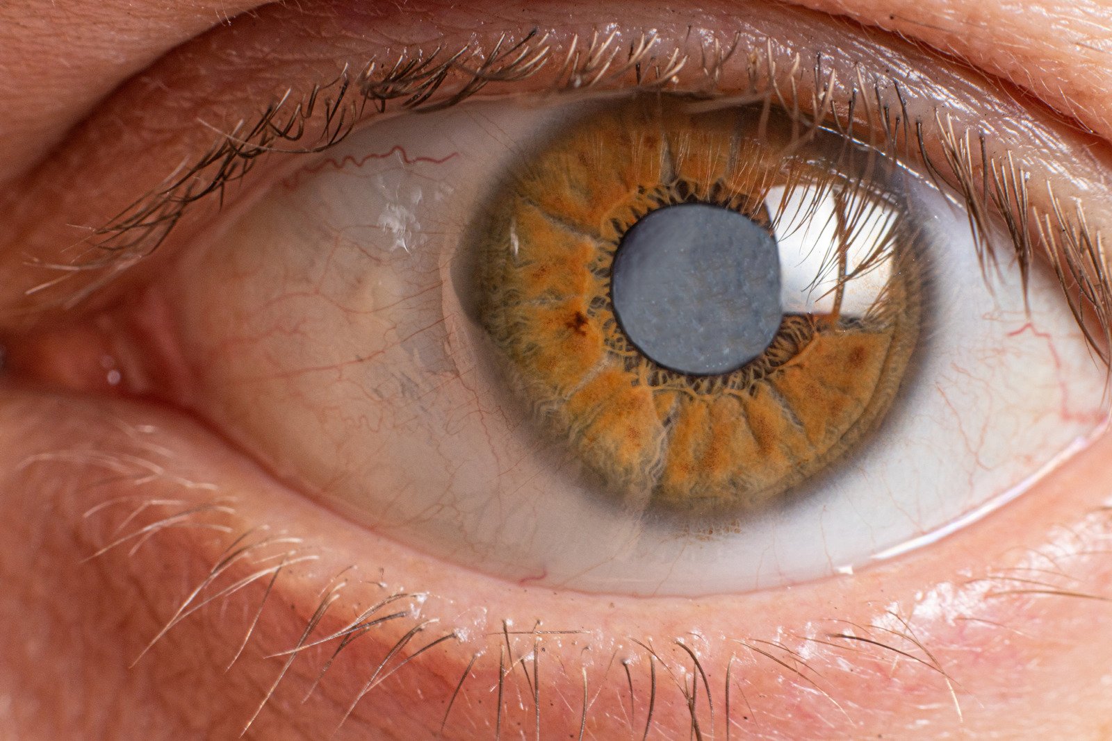 백내장 (Cataract): 수정체 혼탁으로 인한 시력 저하