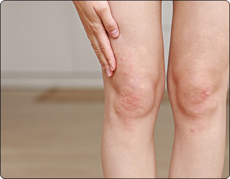 대상포진 예방접종 가격