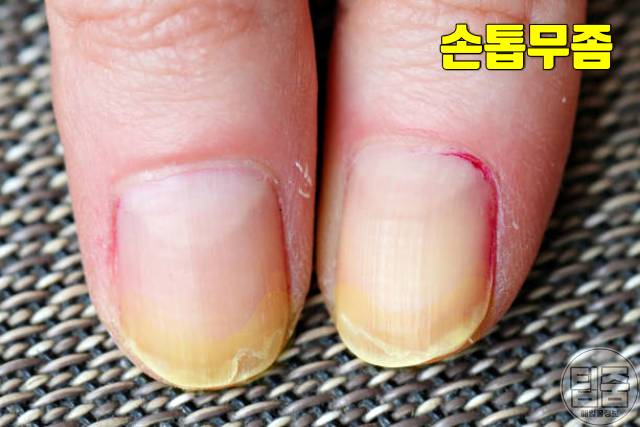 손톱 색깔 건강 손톱색깔 노란색 무좀