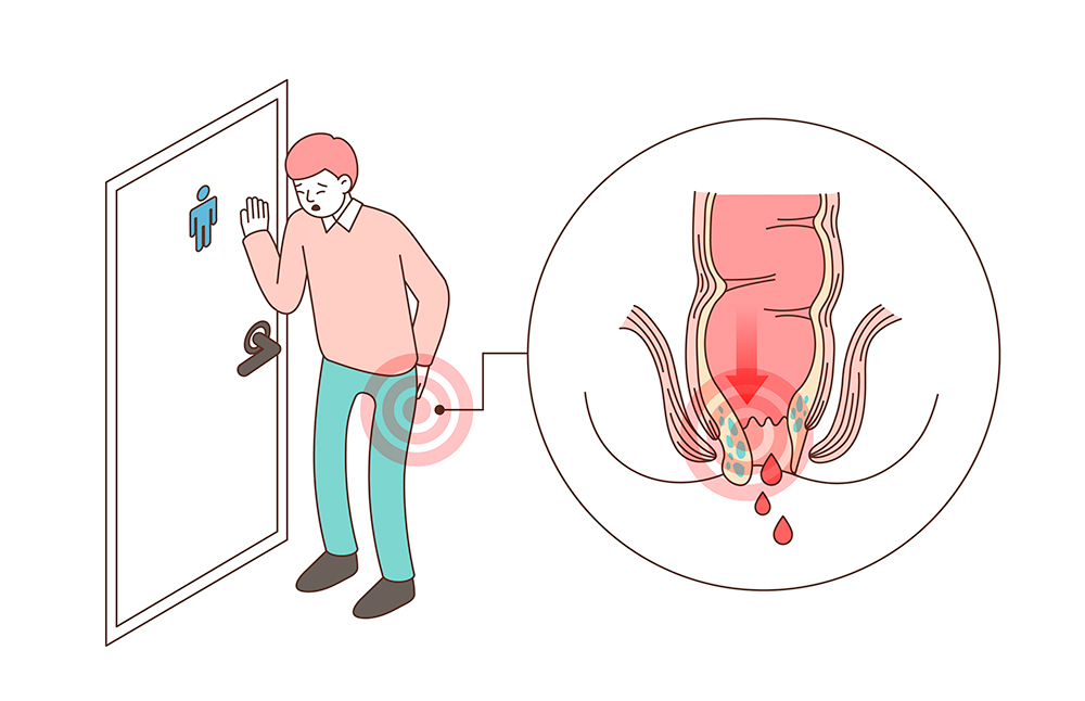 치질연고 인터넷 구매