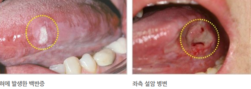 설암