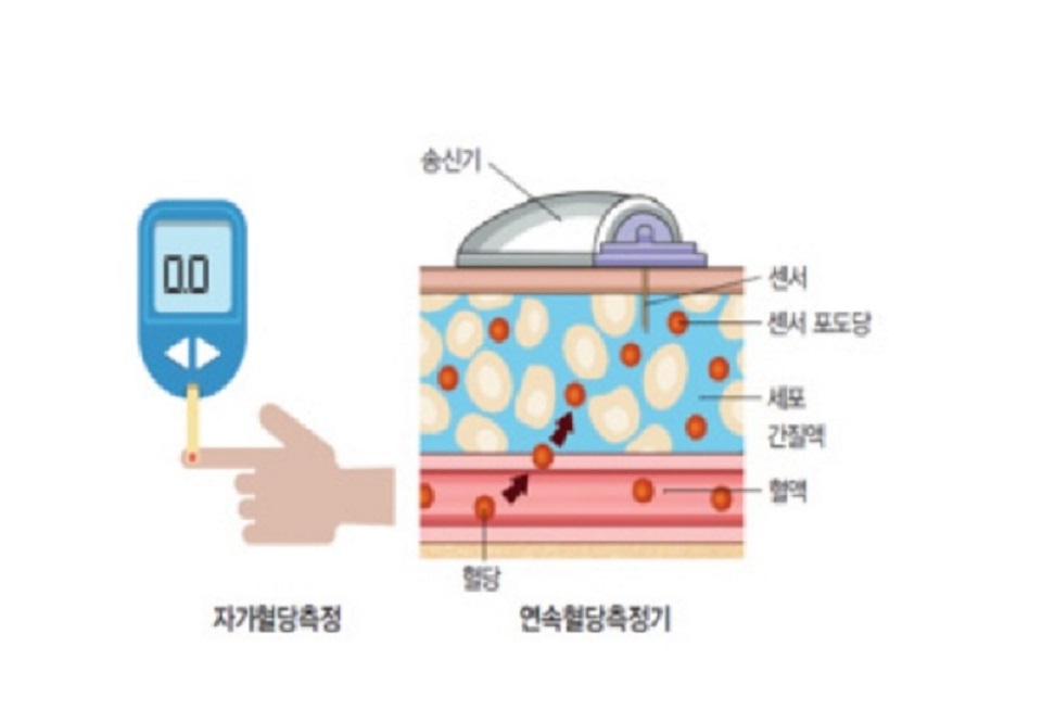 연속혈당측정기설명