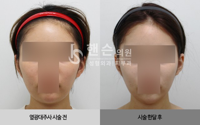 옆광대축소주사