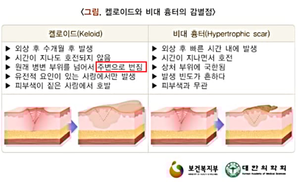 흉터 실리콘 패치 효과 없는 패인 흉터 유형