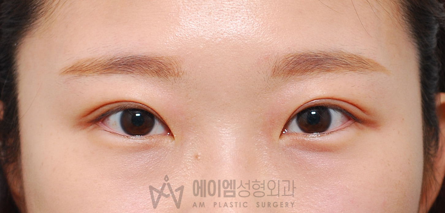 쌍수 붓기 3개월 (절개법)