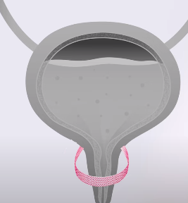 테이프에 과도한 장력