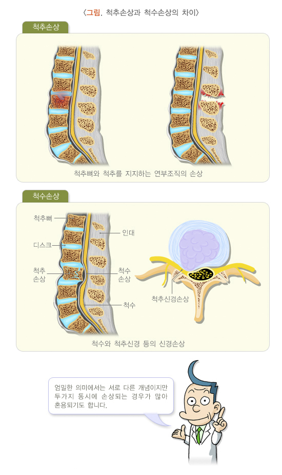 척추골절