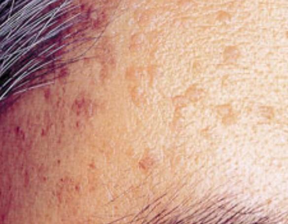 편평사마귀 없애는 방법