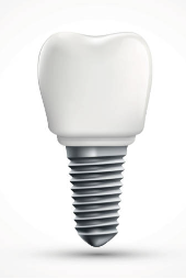 국산 임플란트 종류